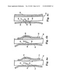 NEEDLELESS DELIVERY SYSTEMS diagram and image