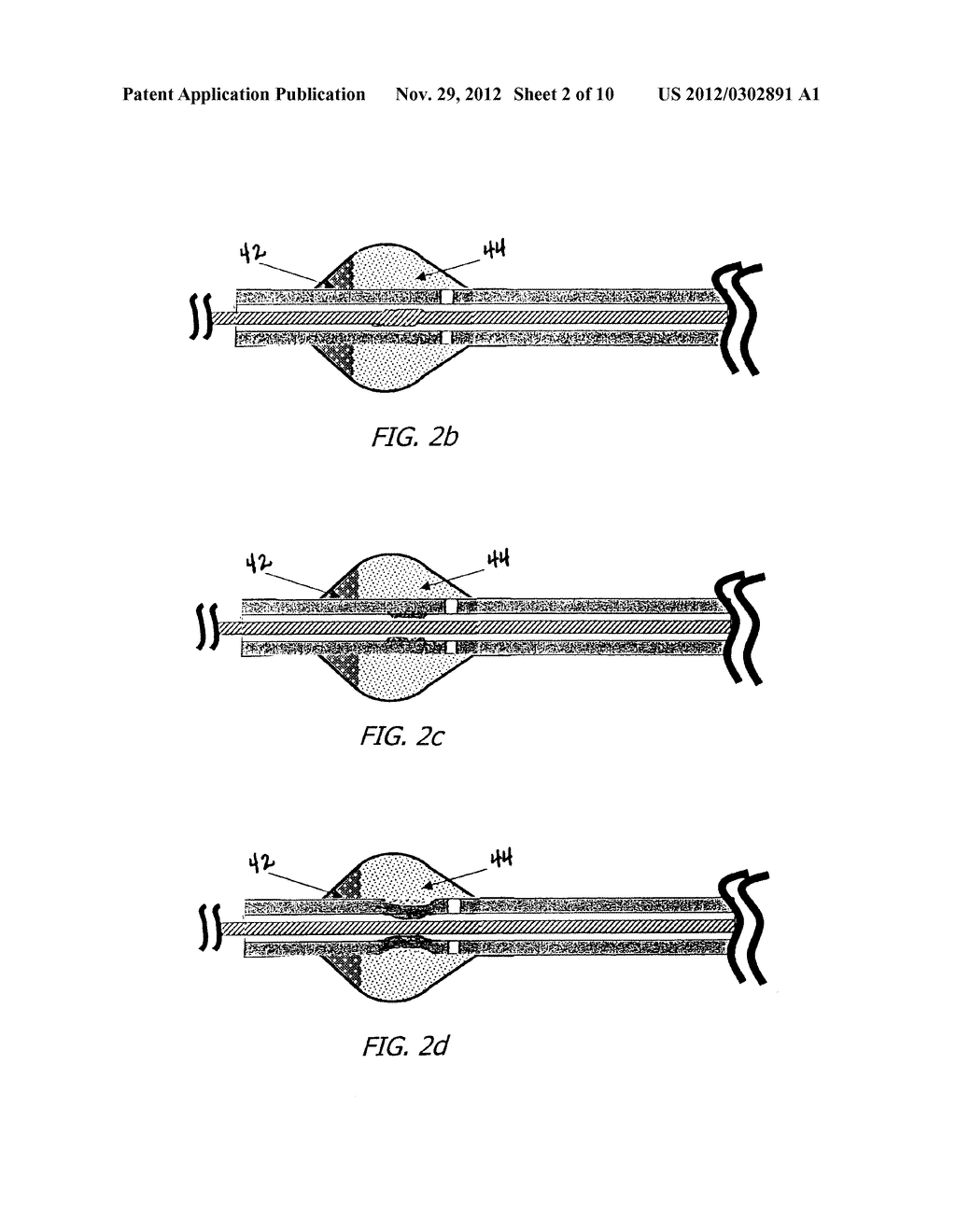 CATHETER MOUNTED AUTOMATIC VESSEL OCCLUSION AND FLUID DISPERSION DEVICES - diagram, schematic, and image 03