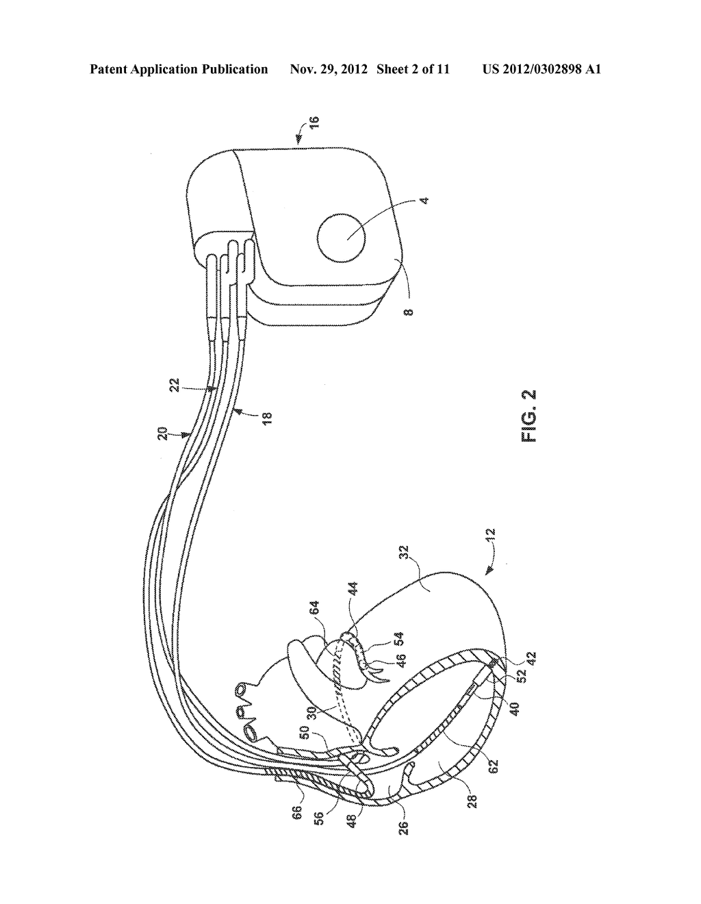 ACOUSTIC BASED COUGH DETECTION - diagram, schematic, and image 03