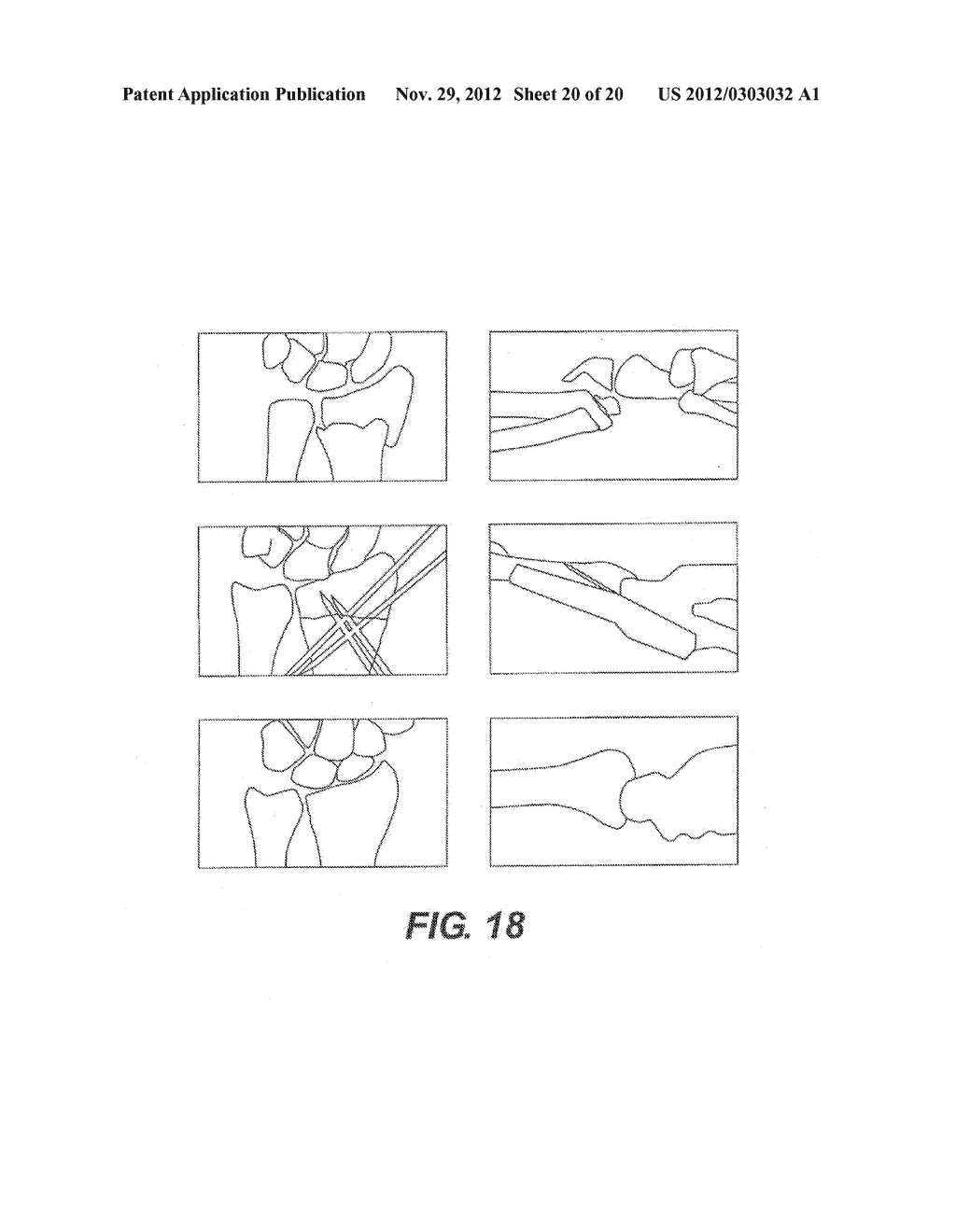 EXTERNAL FIXATION DEVICE FOR FRACTURES - diagram, schematic, and image 21