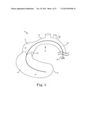 TRANSAPICAL VALVE REPLACEMENT diagram and image