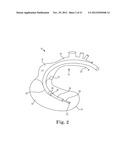 TRANSAPICAL VALVE REPLACEMENT diagram and image