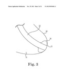 TRANSAPICAL VALVE REPLACEMENT diagram and image