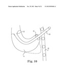 TRANSAPICAL VALVE REPLACEMENT diagram and image