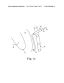 TRANSAPICAL VALVE REPLACEMENT diagram and image