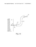 TRANSAPICAL VALVE REPLACEMENT diagram and image