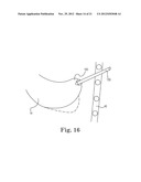 TRANSAPICAL VALVE REPLACEMENT diagram and image