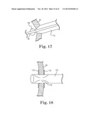 TRANSAPICAL VALVE REPLACEMENT diagram and image