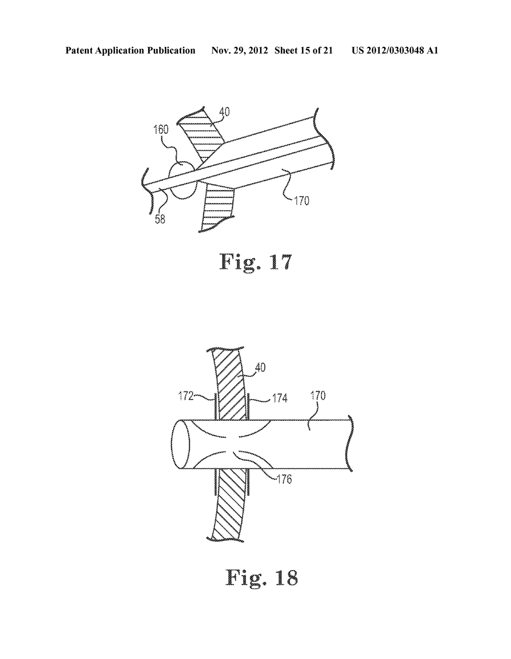 TRANSAPICAL VALVE REPLACEMENT - diagram, schematic, and image 16