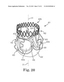 TRANSAPICAL VALVE REPLACEMENT diagram and image