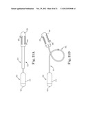 TRANSAPICAL VALVE REPLACEMENT diagram and image