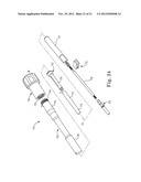 TRANSAPICAL VALVE REPLACEMENT diagram and image