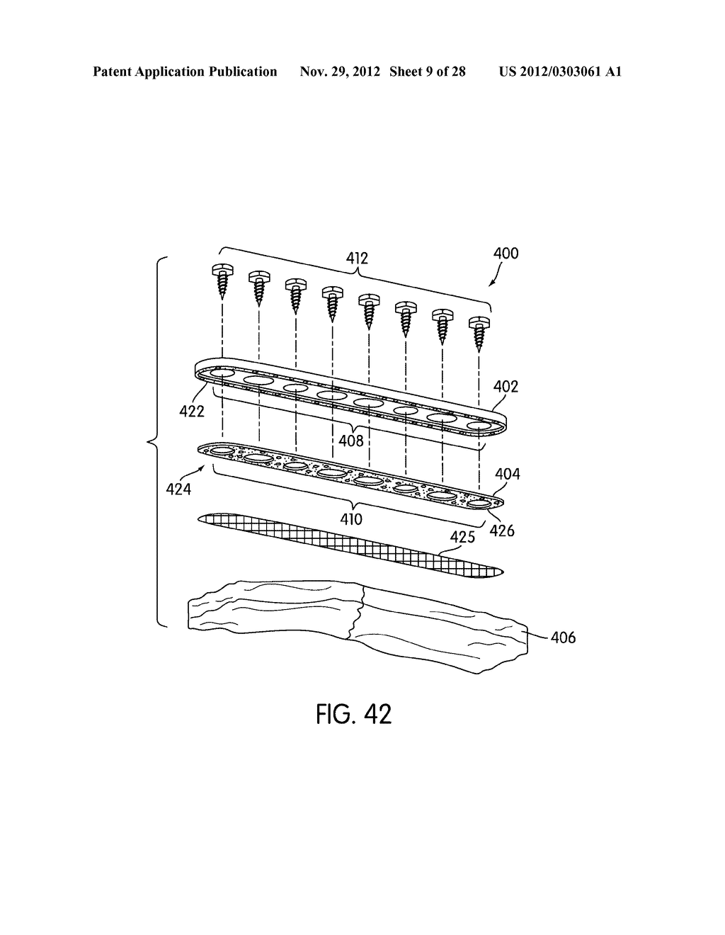 Spinal Fixation with Selectively Applied Bone Growth Promoting Agent - diagram, schematic, and image 10