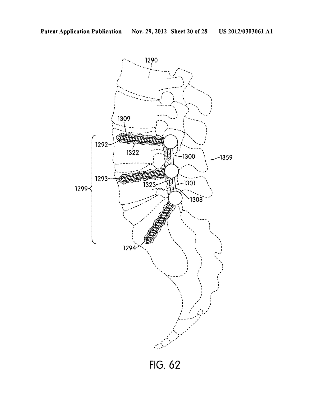 Spinal Fixation with Selectively Applied Bone Growth Promoting Agent - diagram, schematic, and image 21