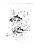 MINIMALLY INVASIVE SPINAL FIXATION SYSTEM INCLUDING VERTEBRAL ALIGNMENT     FEATURES diagram and image