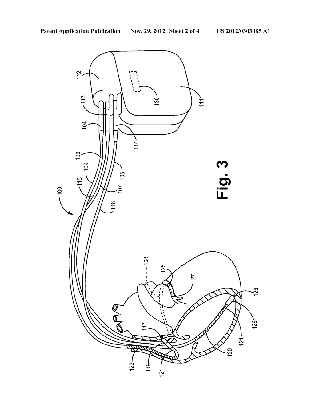 METHODS AND APAPRATUS FOR MANUALLY SUSPENDING INTRATHORACIC IMPEDANCE     FLUID STATUS MEASUREMENTS - diagram, schematic, and image 03