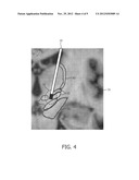 Method and System for Determining Settings for Deep Brain Stimulation diagram and image