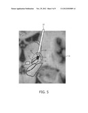 Method and System for Determining Settings for Deep Brain Stimulation diagram and image