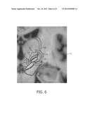 Method and System for Determining Settings for Deep Brain Stimulation diagram and image