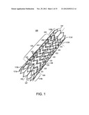 STENT diagram and image