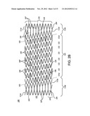 STENT diagram and image