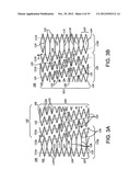 STENT diagram and image