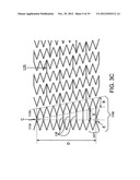 STENT diagram and image