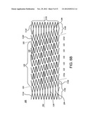 STENT diagram and image