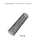 STENT diagram and image