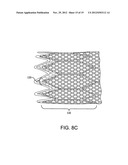 STENT diagram and image