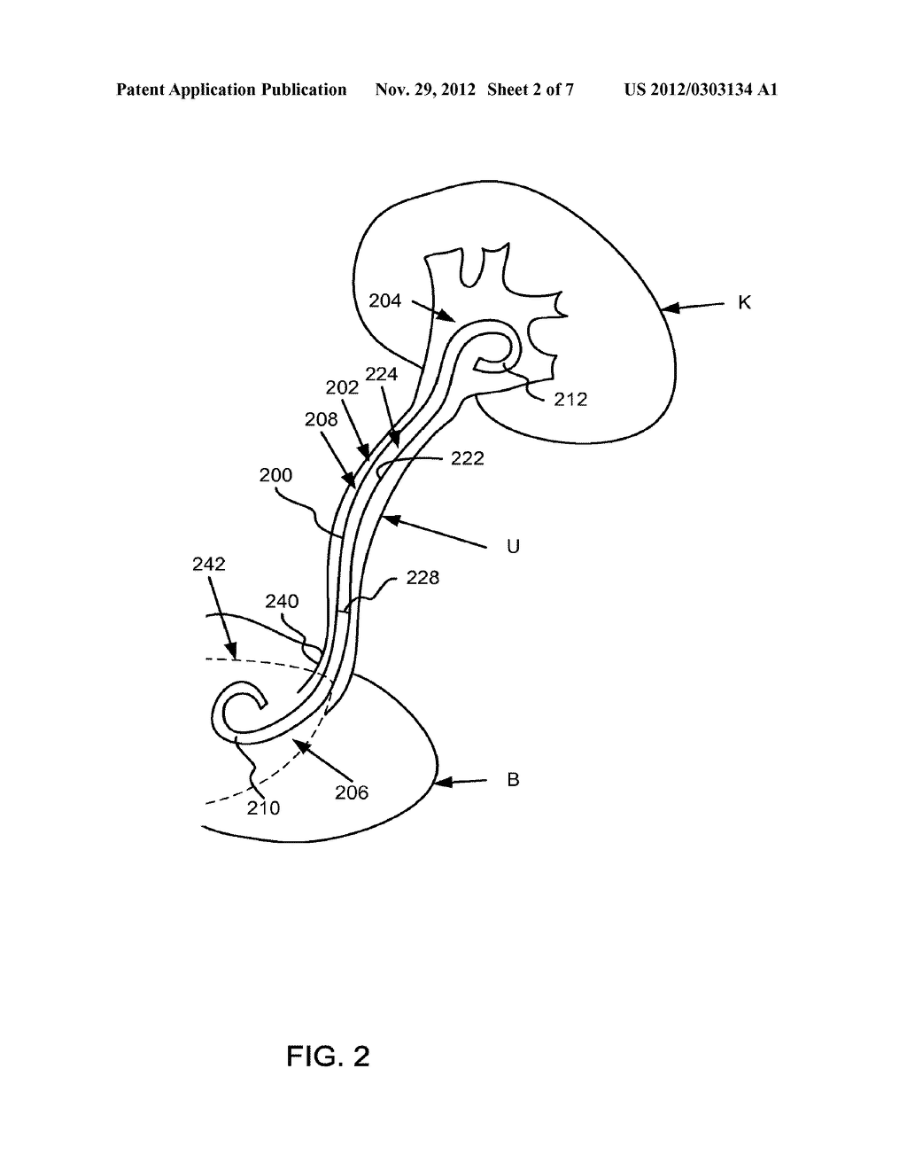 STENT WITH SOLUBLE BLADDER RETENTION MEMBER - diagram, schematic, and image 03