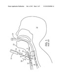 REVERSE TRACHEAL STOMA DILATION METHOD AND APPARATUS diagram and image