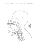 REVERSE TRACHEAL STOMA DILATION METHOD AND APPARATUS diagram and image