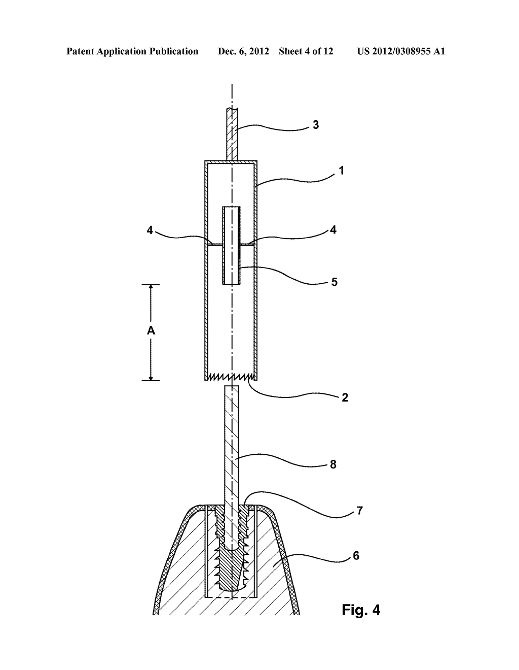 APPARATUS FOR EXPLANTING A DENTAL IMPLANT FROM A HUMAN OR ANIMAL BONE - diagram, schematic, and image 05