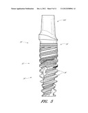 DENTAL IMPLANT diagram and image