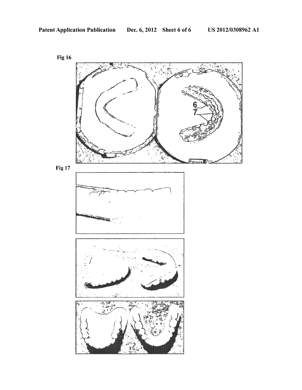 REMOVABLE DENTAL PROSTHESIS WITH FRAMEWORK AND SOFT BASE - diagram, schematic, and image 07