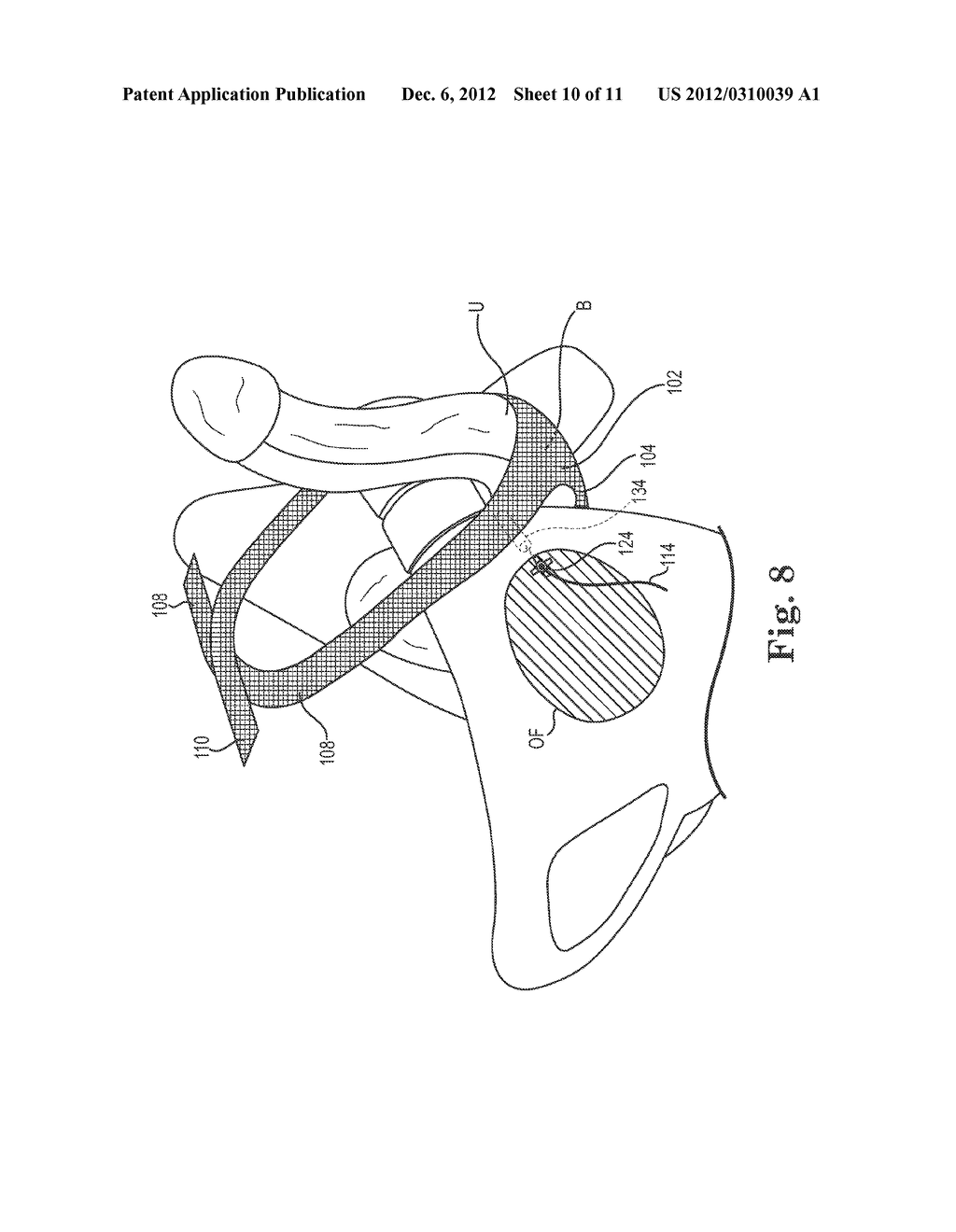 INCONTINENCE TREATMENT DEVICE - diagram, schematic, and image 11