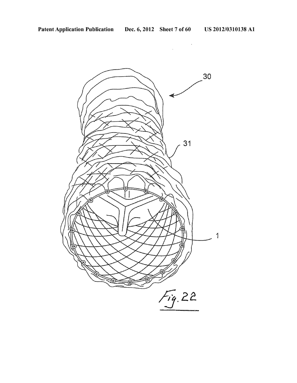 GASTROINTESTINAL IMPLANT DEVICE AND DELIVERY SYSTEM THEREFOR - diagram, schematic, and image 08