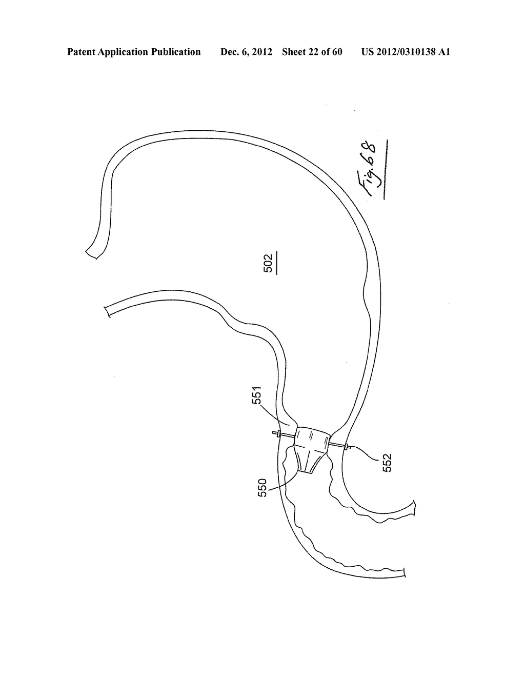 GASTROINTESTINAL IMPLANT DEVICE AND DELIVERY SYSTEM THEREFOR - diagram, schematic, and image 23