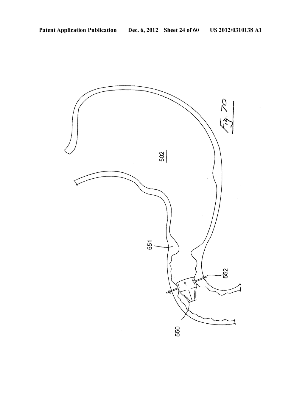 GASTROINTESTINAL IMPLANT DEVICE AND DELIVERY SYSTEM THEREFOR - diagram, schematic, and image 25