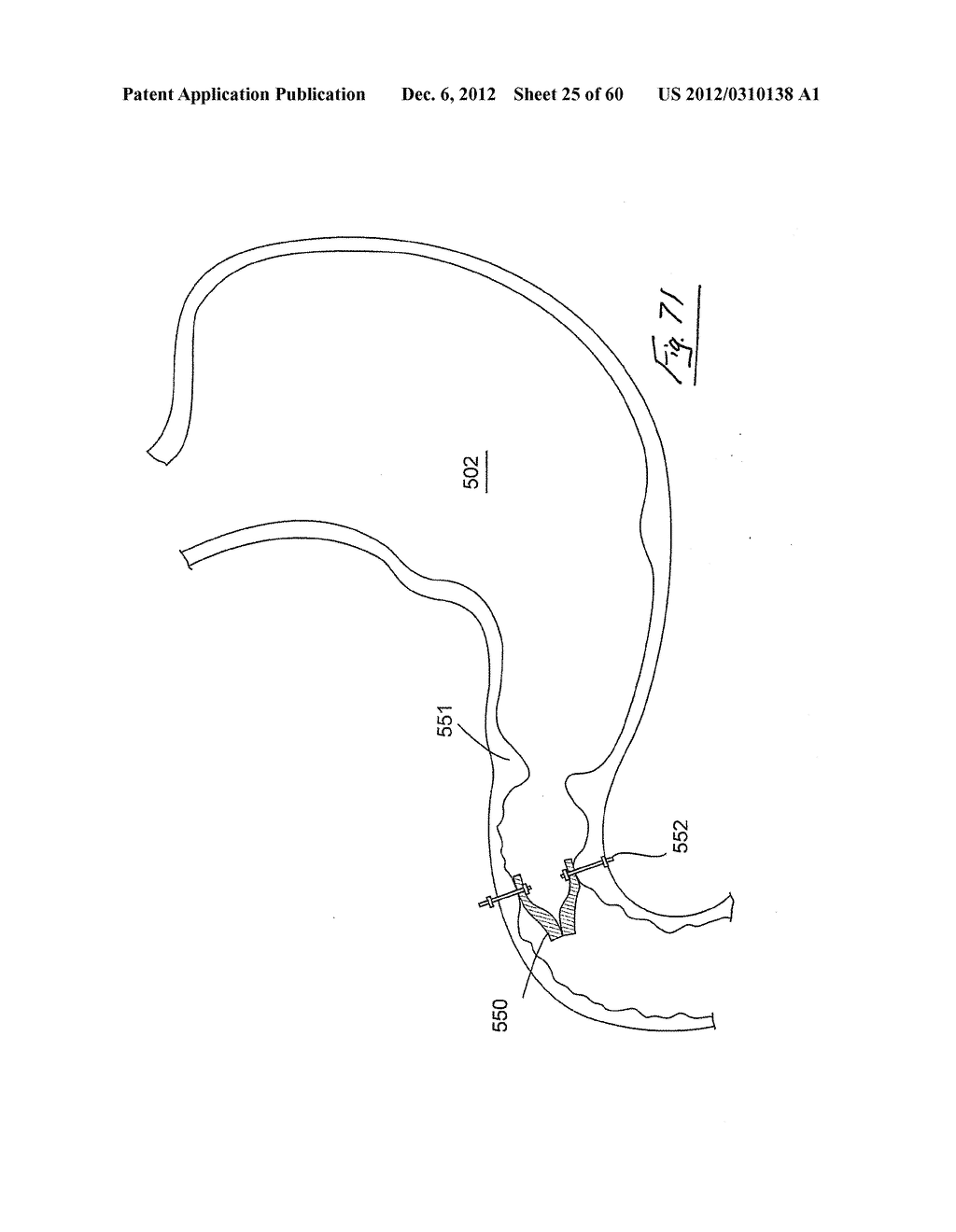 GASTROINTESTINAL IMPLANT DEVICE AND DELIVERY SYSTEM THEREFOR - diagram, schematic, and image 26