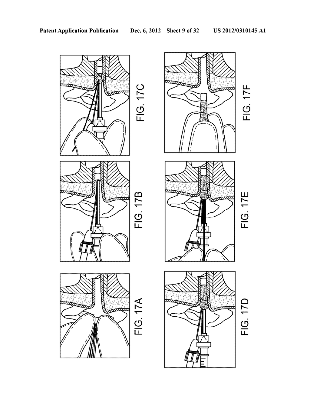 SYSTEM AND METHOD FOR THE SIMULTANEOUS BILATERAL INTEGRATED TYMPANIC DRUG     DELIVERY AND GUIDED TREATMENT OF TARGET TISSUES WITHIN THE EARS - diagram, schematic, and image 10