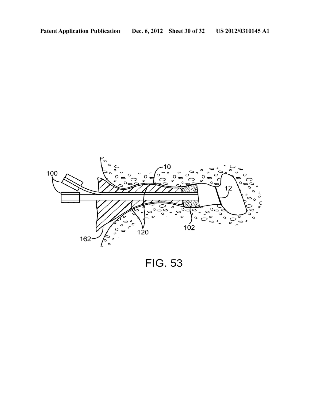 SYSTEM AND METHOD FOR THE SIMULTANEOUS BILATERAL INTEGRATED TYMPANIC DRUG     DELIVERY AND GUIDED TREATMENT OF TARGET TISSUES WITHIN THE EARS - diagram, schematic, and image 31