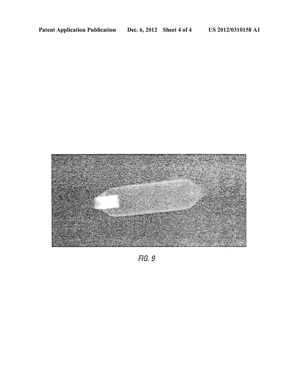 BALLOON CATHETER HAVING METAL BALLOON AND METHOD OF MAKING SAME - diagram, schematic, and image 05