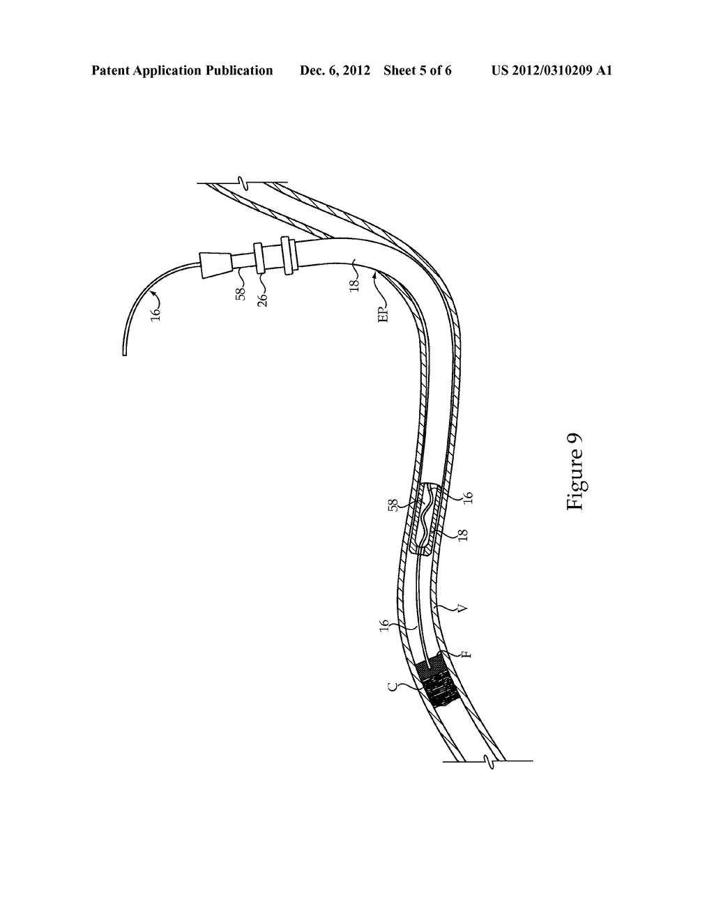 Catheter And Treatment Methods For Lower Leg Ischemia - diagram, schematic, and image 06