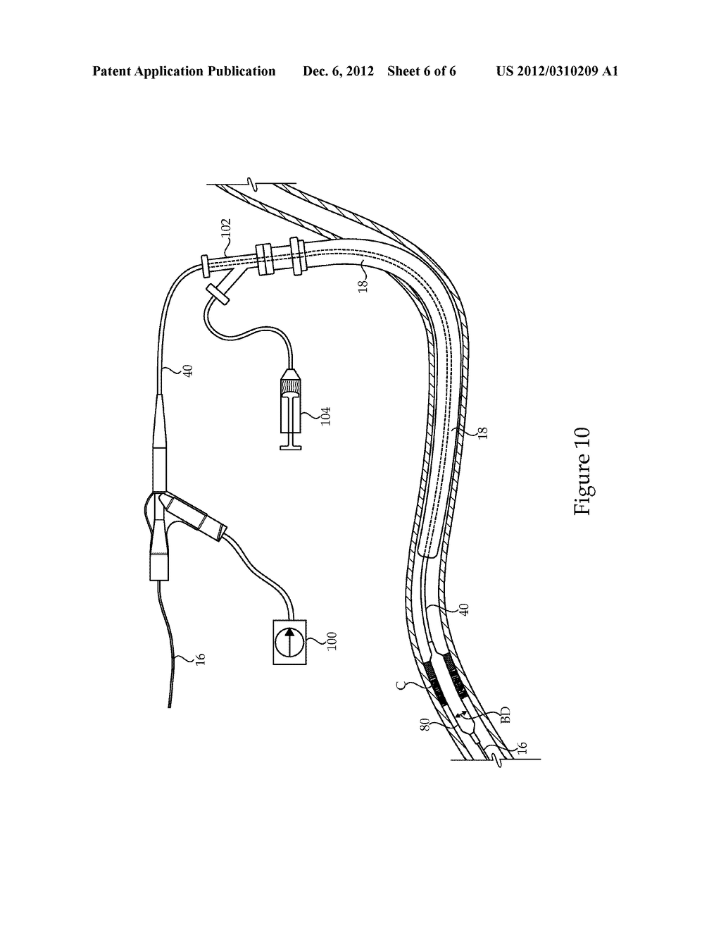 Catheter And Treatment Methods For Lower Leg Ischemia - diagram, schematic, and image 07