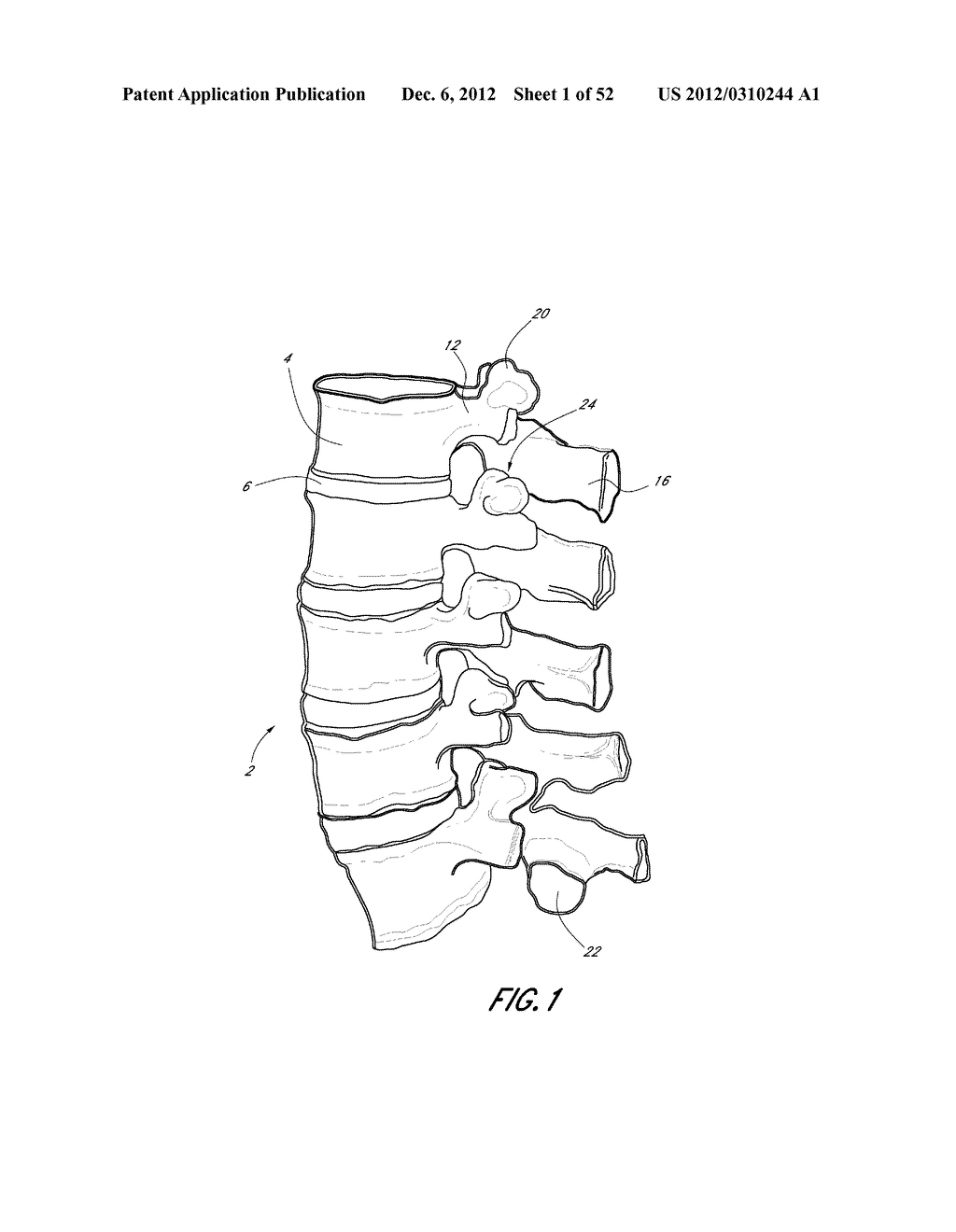 METHOD OF USING A VERTEBRAL FACET JOINT DRILL - diagram, schematic, and image 02