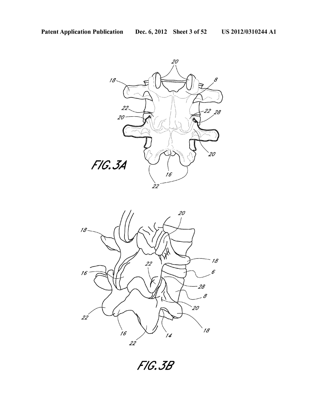 METHOD OF USING A VERTEBRAL FACET JOINT DRILL - diagram, schematic, and image 04
