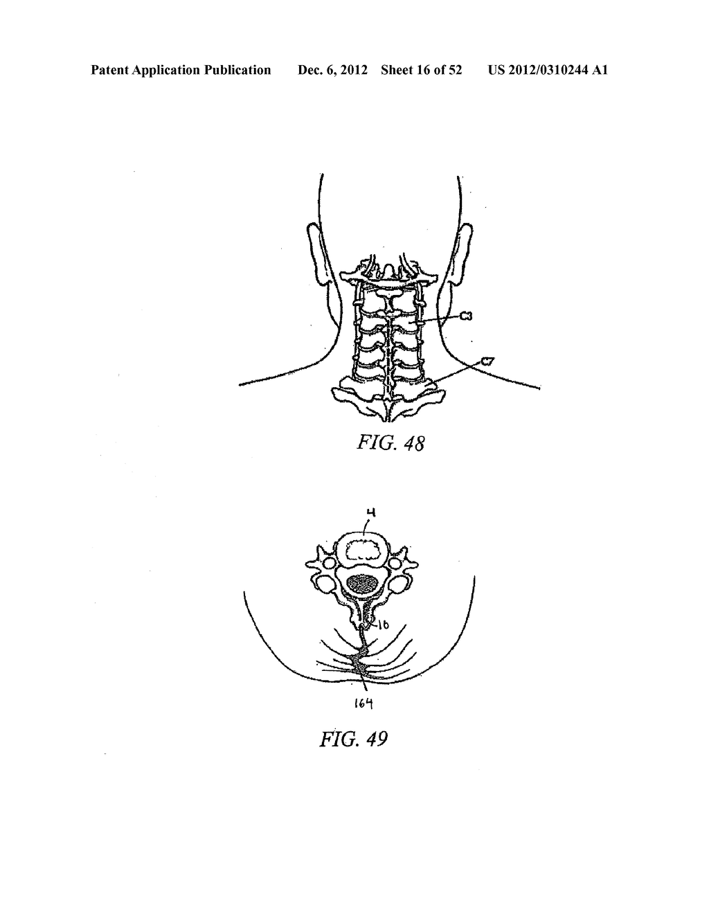 METHOD OF USING A VERTEBRAL FACET JOINT DRILL - diagram, schematic, and image 17