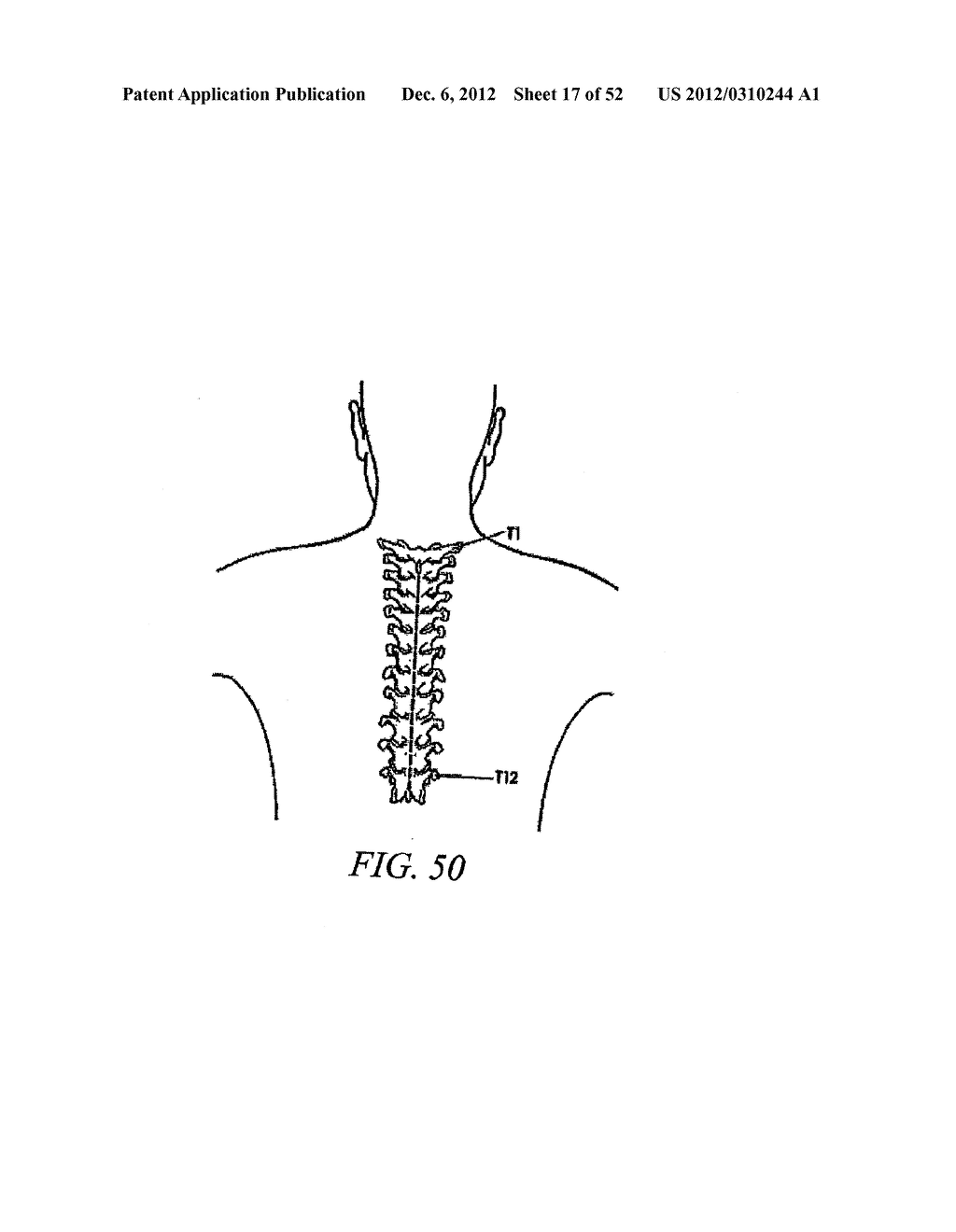 METHOD OF USING A VERTEBRAL FACET JOINT DRILL - diagram, schematic, and image 18